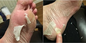 'Baby Foot' Makes Your Feet Peel Like a Snake And It's Amazing
