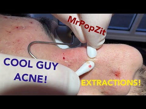 NEW PATIENT! NEW POPS! COOL GUY ACNE PART 1. Blackheads, whiteheads extracted! 20 minutes of pop!