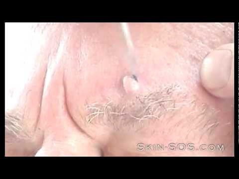 Wart Removal on Face| The Secret to Natural Face Wart Removal