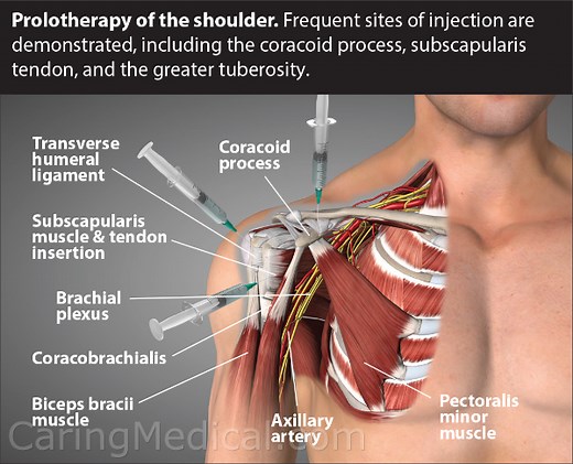 Alternatives to Rotator Cuff Tear Surgery - Rotator Cuff injections