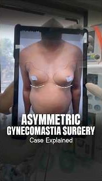 Uneven Chest Fixed! | Asymmetric Gynecomastia Transformation