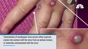 What is Monkeypox?