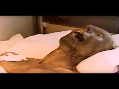 Acute radiation syndrome the Ministry of defense of the USSR 1988 HD