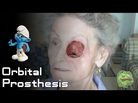 Orbital Prosthesis | Artificial Eye Implant