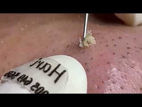 Extreme Blackhead Removal | For Stress Relief | Deep Pore Cleaning & Satisfying Extraction #4030