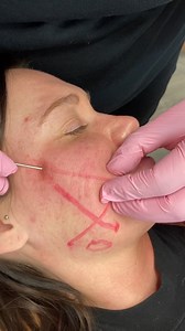We love this procedure for tightening, smoothing, and lifting the skin! What do you think about PDO Threads? | American Academy of Facial Esthetics | Facebook