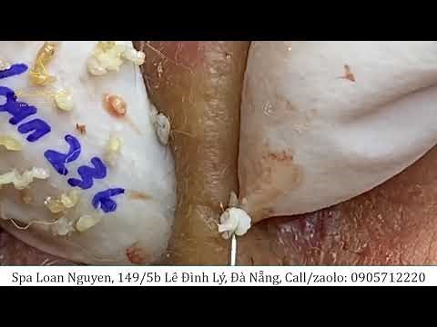 Remove pustules, inflammation for male customers 236