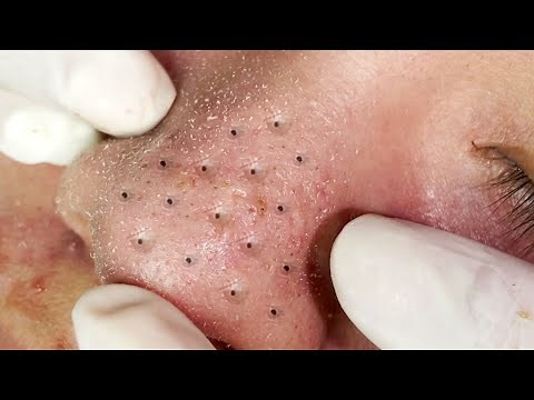 Suri Job #530: Awesome Blackheads on Nose