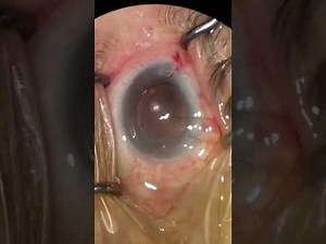 Extra Capsular Cataract Extraction ECCE