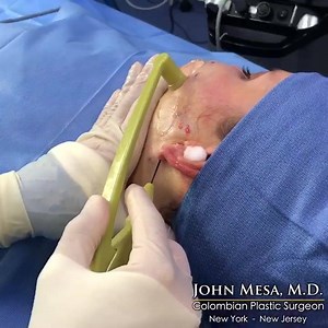 18 reactions |  FACETITE: The minimally invasive procedure that...