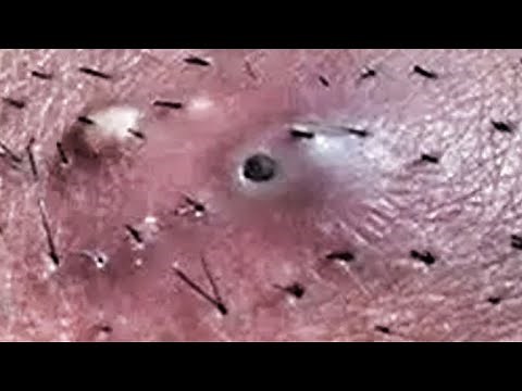 Ingrown Hair! 15 Ingrown Hair Removal Extended