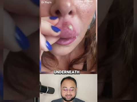 Huge Cyst Popping Compilation 😳 | Hard to Watch 😱