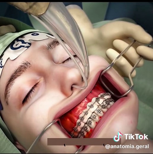 #CapCut #osteotomiamaxilar #osteotomiamandibular #anatomia #anatomy #medical #ag♿️