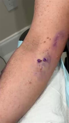 ✨ Ever wondered how neurofibroma is treated? From cleansing and numbing the area, to careful excision and electrocautery for healing — here’s a closer look at the step-by-step procedure. 喙 #Neurofibroma #SkinHealth #MedicalCare | Anna Chacon, MD FAAD | Facebook