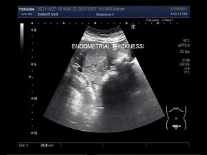 Endometrial Hyperplasia, patient aged 37 years.