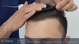 Trapianti di capelli effettuati in prima persona dal Dottor Resul Yaman. Per Info e dettagli: ✅ Numero: +39 348 563 5992  Email: italia@resulyaman.com ℹ️ www.resulyaman.it | Trapianto di Capelli - Dr Resul Yaman | Facebook