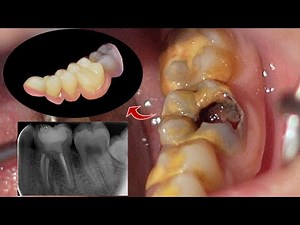 Root Canal Treatment of a Mandibular First Molar Tooth with Huge Tartar or Calculus | Pulp Polyp.