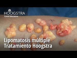 Lipomatosis múltiple - Tratamiento Hoogstra - 23124