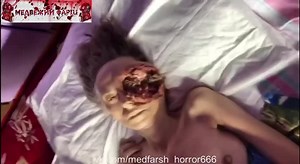 MEDICAL PURPOSE! WHAT EYE LID CANCER LOOKS LIKE