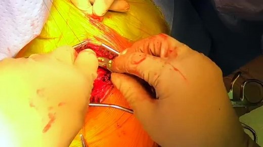 Clavicle Fracture Open Reduction and Internal Fixation with Coracoclavicular Ligament Repair