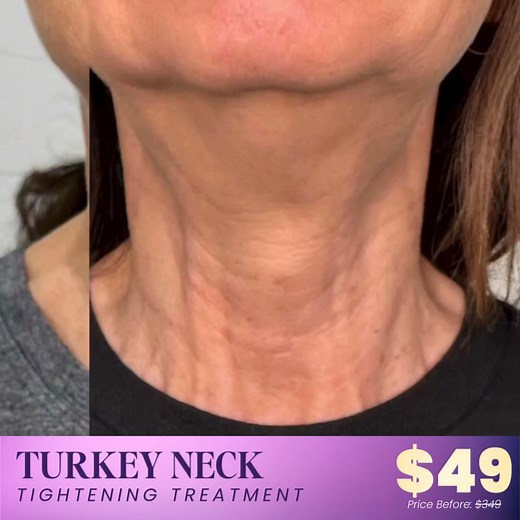 👋Hey San Francisco Ladies! Still struggling with sagging skin, deep neck lines, or that dreaded “turkey neck” that’s hard to hide? This season, give yourself the gift of a firmer, tighter, youthful-looking neckline with our Holiday Turkey Neck Rescue Treatment!🎁 This advanced, non-invasive treatment lifts and tightens the neck area — just in time for holiday parties, family gatherings, and every glowing photo moment. What Our Turkey Neck Rescue Helps Improve: 🔹 Loose, crepey neck skin 🔹 Sagg