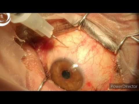 800 how to inject intravitreal to avoid endophthalmitis
