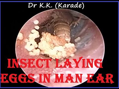 Alive Insect ( Fly ) Removal from ear & one more surprise inside
