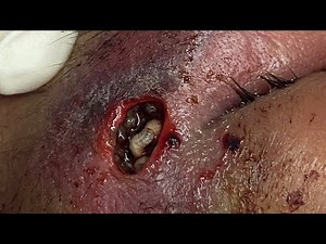 || Maggots removal from deep open wound in DDU hospital ||
