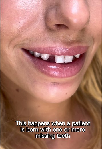 Transforming Smiles: Hypodontia Treatment Explained