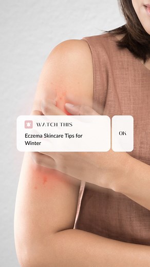 7.2K views · 36 reactions | Dealing with eczema during winter can be...