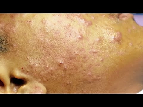 Extraction boutons et acné kystique (cystic acne) sur le visage