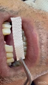 Ribbond bridge fiber reinforcement composite, composite bridge single visit bridge done by dr. dina | دكتور اسنان في اربيل دكتوره دينا قاسم مالك جامعه بغداد ١٩٩٢ /٠٧٥٠٥٥٧٨٥٥٨