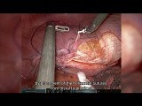 The Use of Quill® Barbed Suture for Robotic Diaphragmatic Plication • Video • MEDtube.net