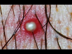 Whitehead or Ingrown Hair: What is this? Dr. Popper's Pimples, Cysts, Boils