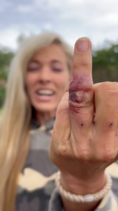 Girl Gets Possible DEADLY Infection from fishing! update | Darcizzle Offshore
