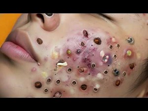 Loan Nguyen Acne Treatment 69ss