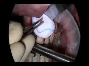 LIVE OPERATION Root Tip Resection with retrograde Filling