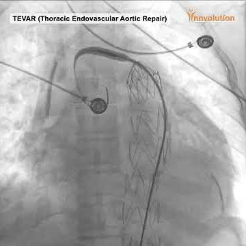 TEVAR Thoracic Endovascular Aortic Repair performed on Pinnacle Agile