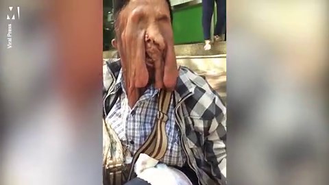 Woman with rare 'melting face' condition refuses surgery