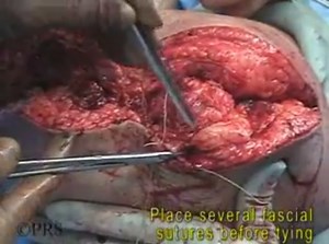 Transfemoral Amputation Surgery