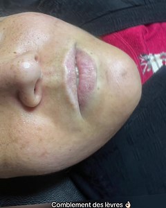 Comblement des lèvres ⚜️ sous rendez-vous Adresse : les tours mobillart tours c 16 étage 📍Oran ☎️☎️: 0796735348 / 0552313208 #Beyrouthbeautycenter #combomix #microblanding | Beyrouth Beauty Center