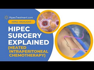 Hipec Treatment Explanation | HipecTreatment.com
