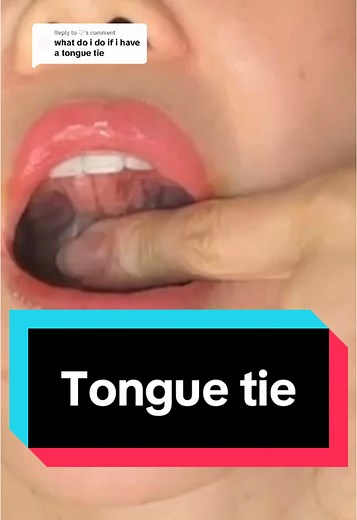Understanding Frenulum Stretch and Tongue Tie Surgery