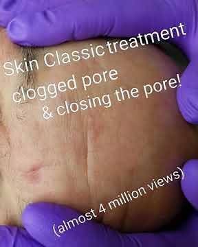 Skin Classic specialty treatment of massive clogged pore