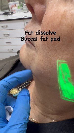 Easy easy easy fat dissolve at zclinic #fatdissolve#pacman#bucalfatpad#fat  03958018 | Carole Zamroud - Z. Clinic Beirut/Dubai | Facebook