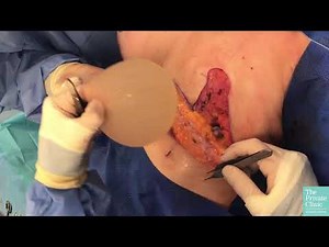 Breast Auto Augmentation Procedure