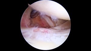 A Novel Technique for Combined Arthroscopic Biceps Tenodesis and Subscapularis Tendon Repair