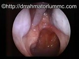 Right Inferior Meatal Antrostomy with Antral Polyps • Video • MEDtube.net