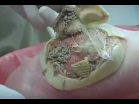 Maggot Debridement Therapy (MDT)