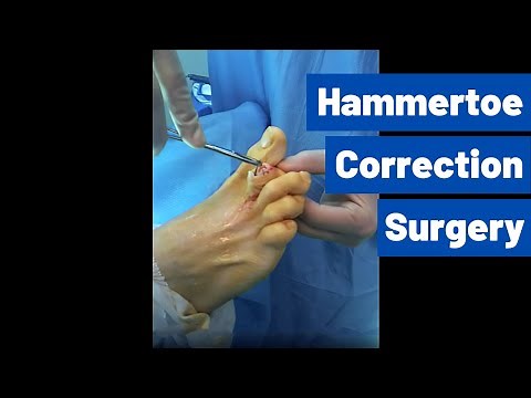 Hammertoe Correction Surgery (Using a 'Smart Toe' Implant) | Moore Foot and Ankle Specialists